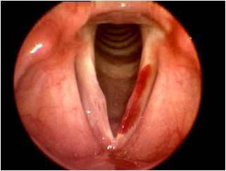 Vocal-fold-hemorrhage.jpg